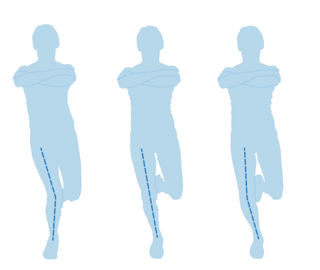 Dynamischer X-Bein-Kollaps des Beines (links) mit hohem Verletzungspotential als Folge der anatomischen Beinachse, einer Schwäche der Hüftmuskulatur (Außenrotatoren) oder koordinativer Defizite. Bildquelle: www.stop-x.de